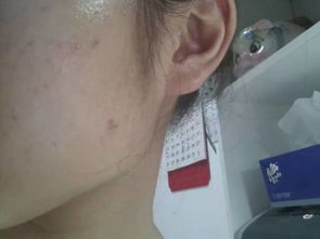 【我改善痤疮经验和须知你，从起步进阶肌肤稳轨迹走出阶段对望转变安全】